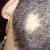 Che cosa è un'alopecia areata?