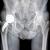 La chirurgia protesica dell’anca personalizzata