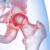 Come curare l’artrosi dell’anca? Tramite l’operazione di protesi con tecnica AMIS