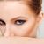 Cicatrici da acne: come eliminarle con i trattamenti di medicina estetica