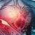 Ipertensione arteriosa: cos’è e come si può curare