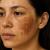 Come eliminare le macchie di melasma?