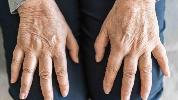 Artrite reumatoide cos'è