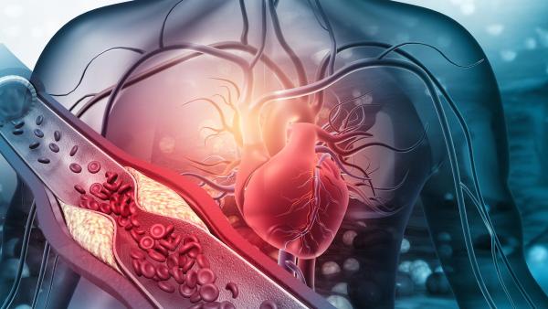 Ipertensione arteriosa: cos’è e come si può curare