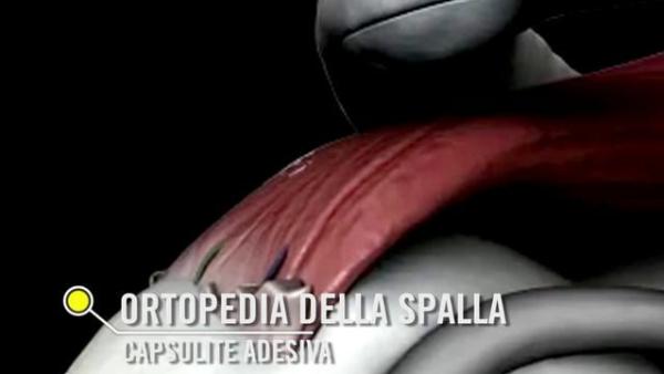 Il Trattamento della Spalla Congelata