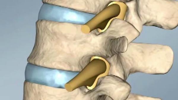 UPPER CERVICAL: I BENEFICI