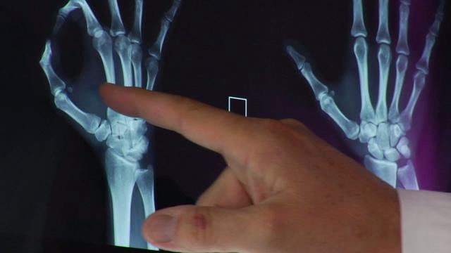 Ortopedia della Mano: Artrosi trapezio-metacarpale